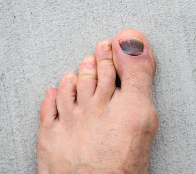 Why Runners Should See an Align Chiropodist